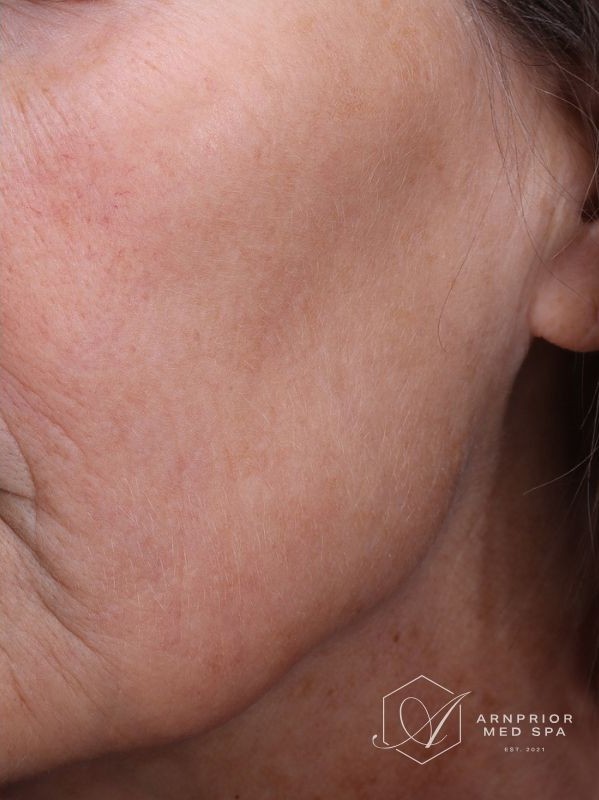 Hyperpigmentation after Laser Toning in Arnprior Ontario