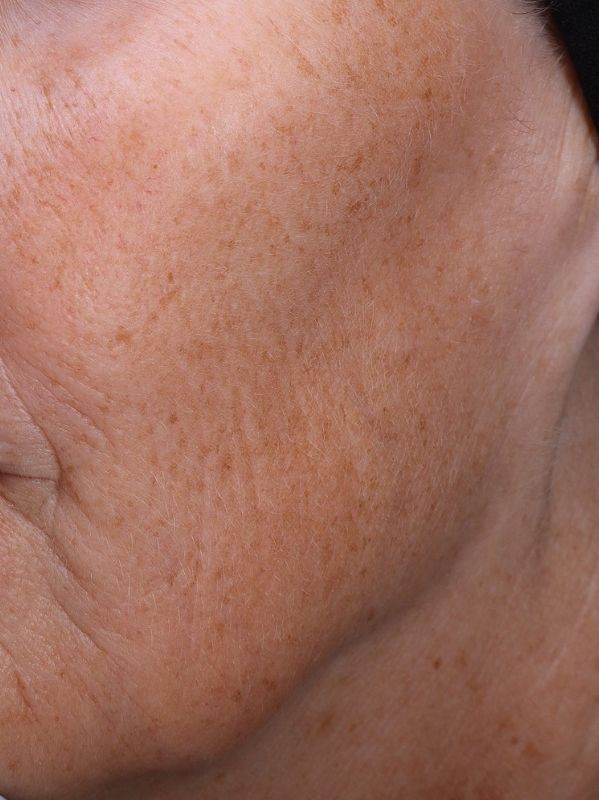 Hyperpigmentation before Laser Toning in Arnprior Ontario