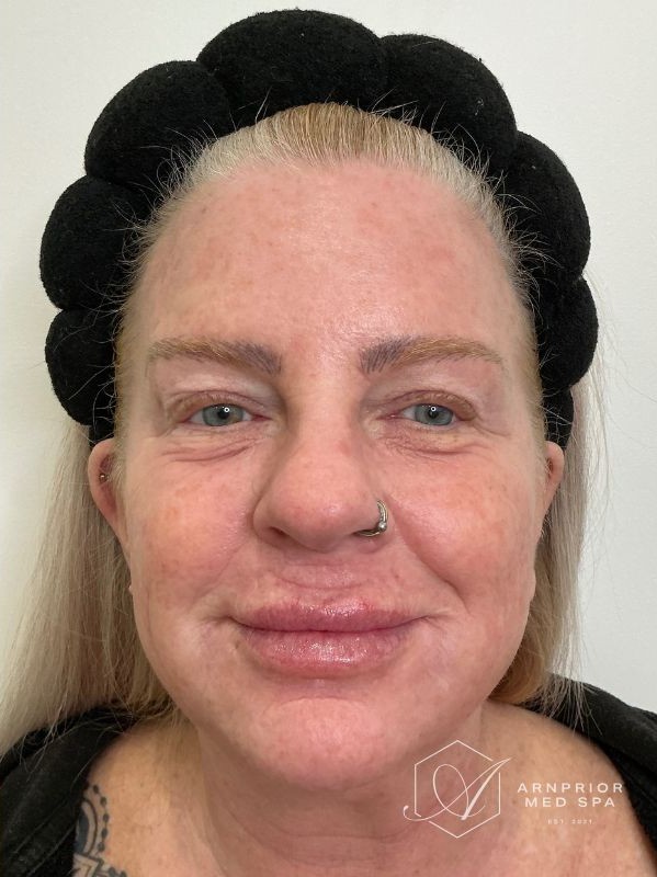Dark spots after CO2 Skin Resurfacing