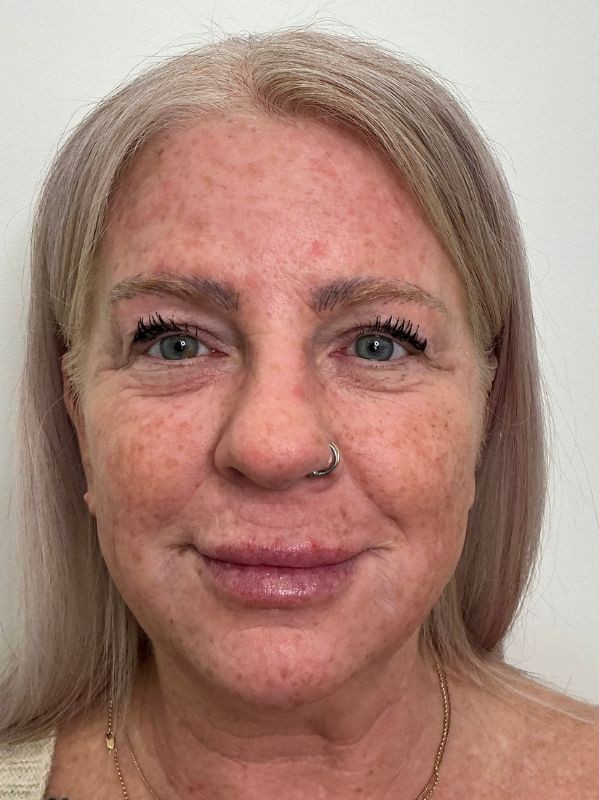 Dark spots before CO2 Skin Resurfacing