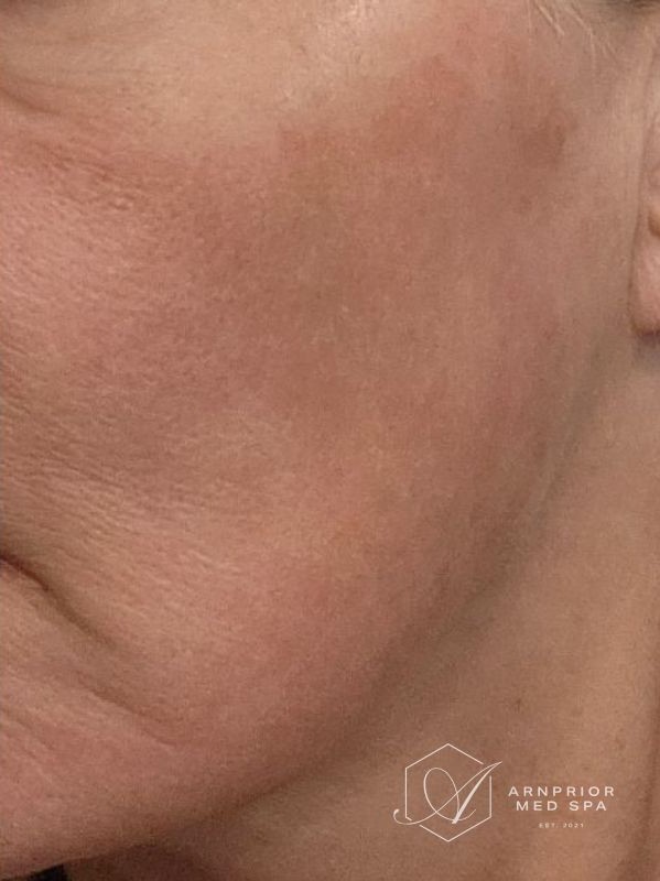 Hyperpigmentation after LaseMD laser resurfacing and laser toning