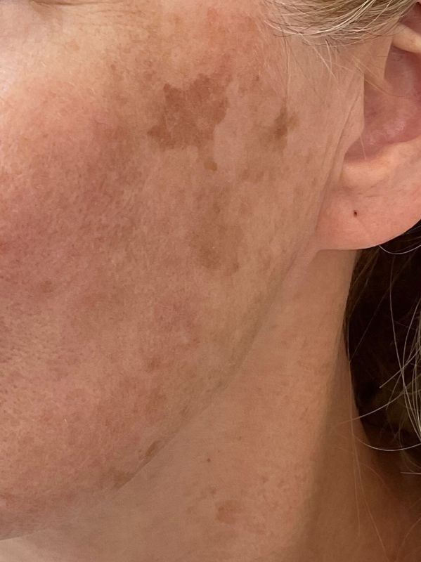 Hyperpigmentation before LaseMD laser resurfacing and laser toning