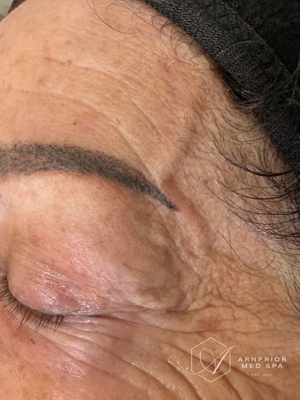 Improvement after Plexr Session for BENIGN LESION REMOVAL, after