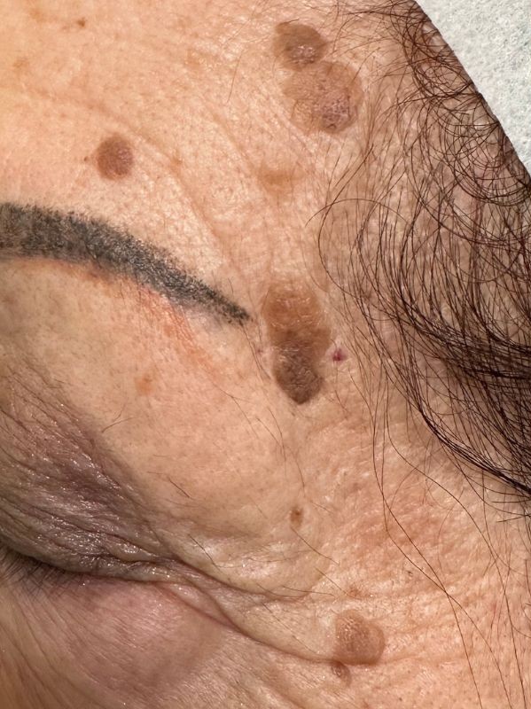 Improvement after Plexr Session for BENIGN LESION REMOVAL, before