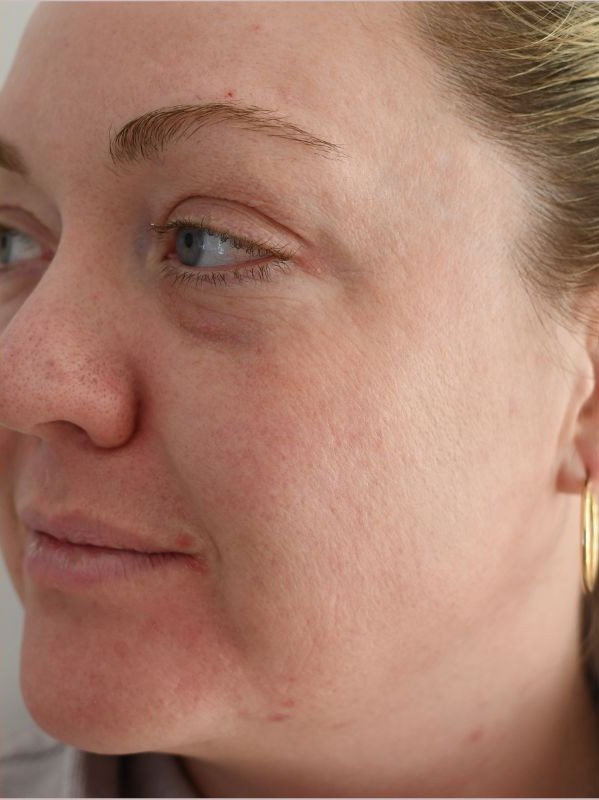 Lines and skin texture on the cheek after CO2 skin resurfacing at Arnprior Med Spa