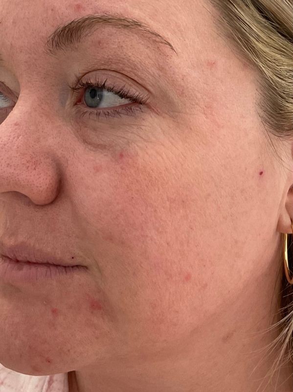 Lines and skin texture on the cheek before CO2 skin resurfacing at Arnprior Med Spa