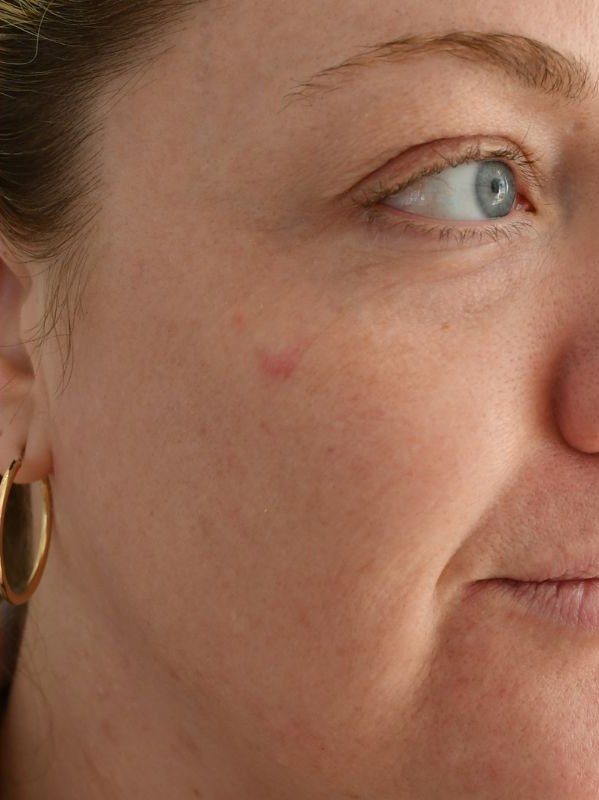 Lines around the eye and cheek after CO2 skin resurfacing at Arnprior Med Spa