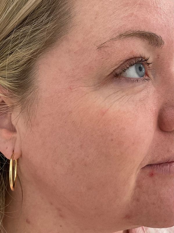 Lines around the eye and cheek before CO2 skin resurfacing at Arnprior Med Spa