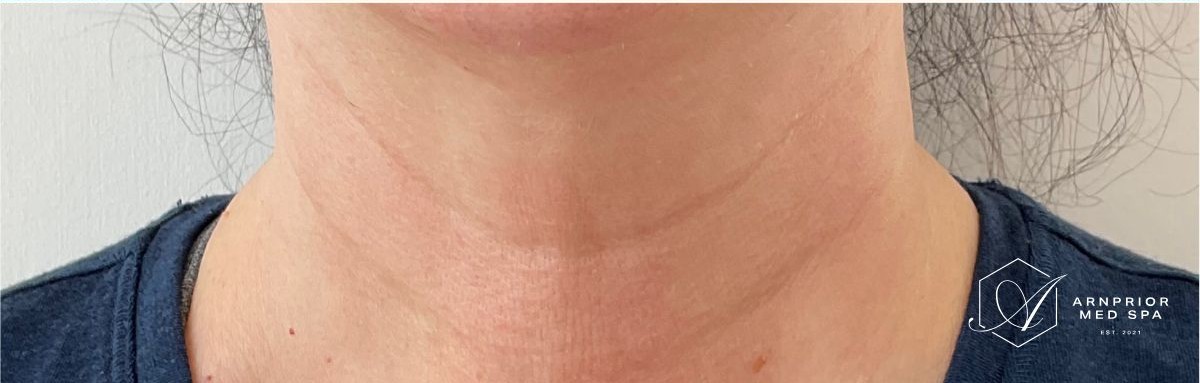 Neck skin tightening after RF Microneedling