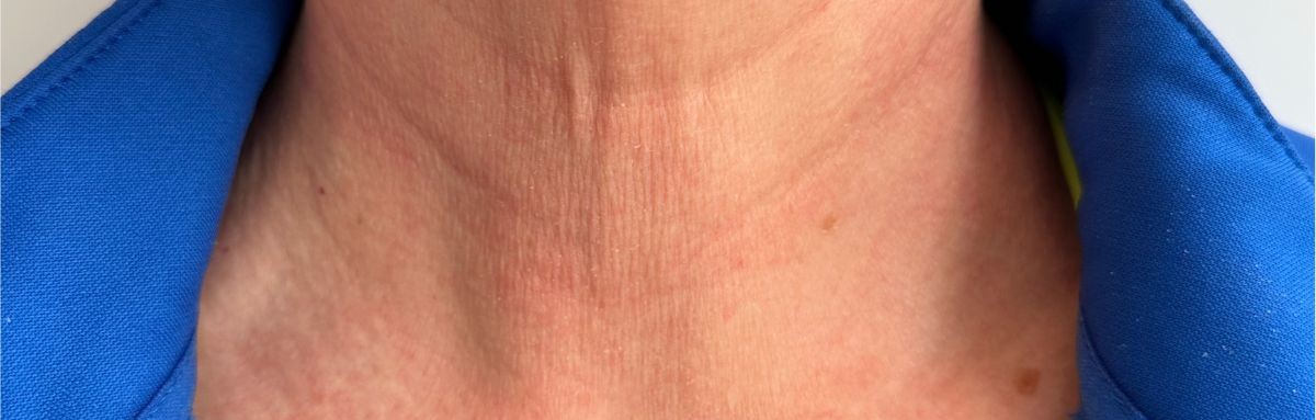 Neck skin tightening before RF Microneedling