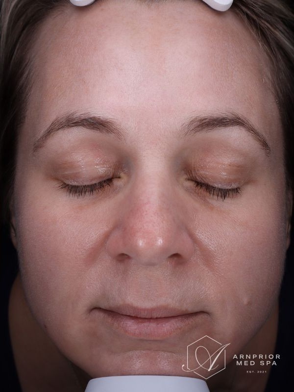 Melasma and hyperpigmentation after LaseMD Ultra laser skin resurfacing at Arnprior Med Spa