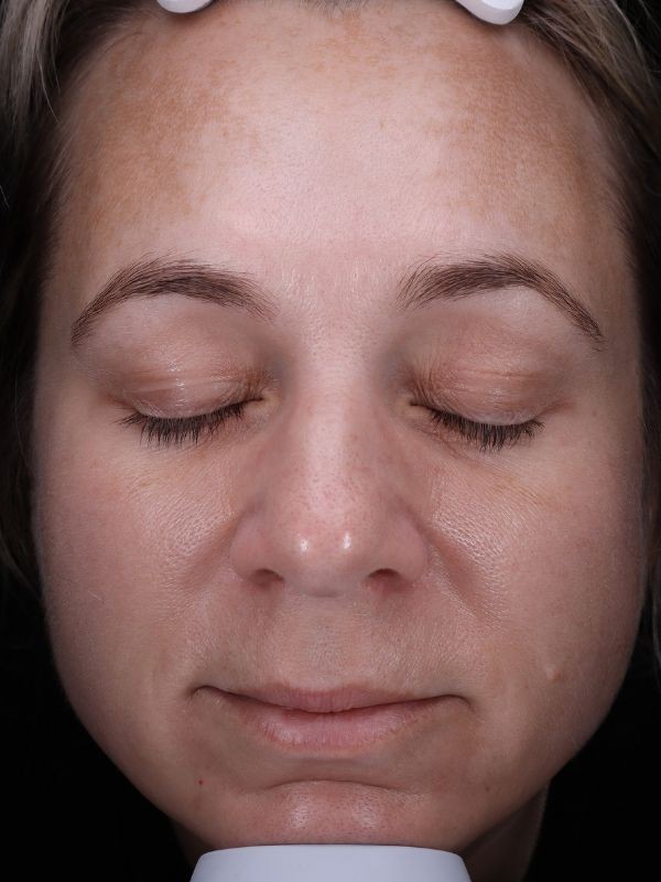 Melasma and hyperpigmentation before LaseMD Ultra laser skin resurfacing at Arnprior Med Spa