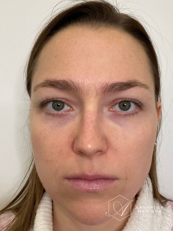 Pigmentation and photodamage after LaseMD Ultra laser skin resurfacing at Arnprior Med Spa