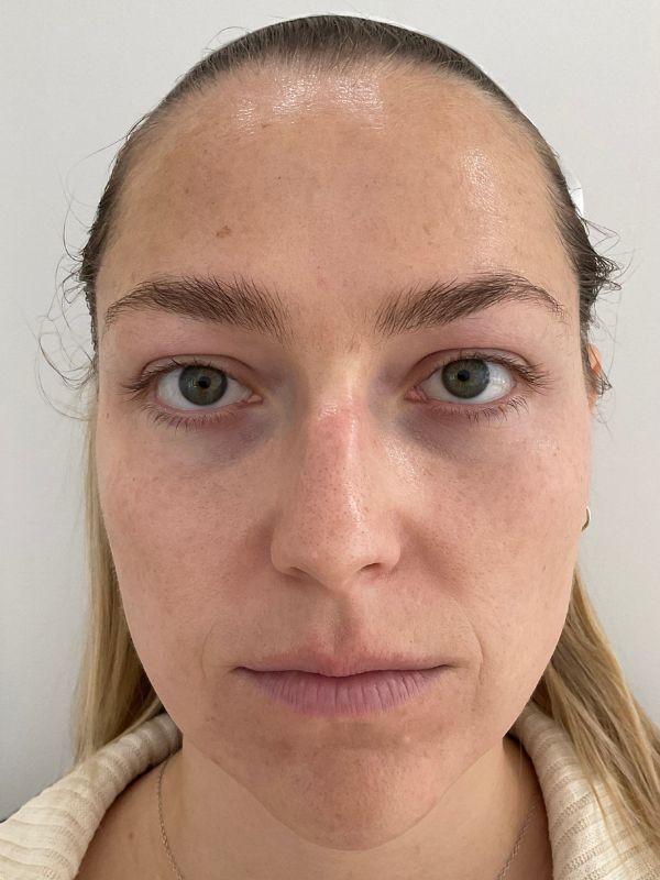 Pigmentation and photodamage before LaseMD Ultra laser skin resurfacing at Arnprior Med Spa