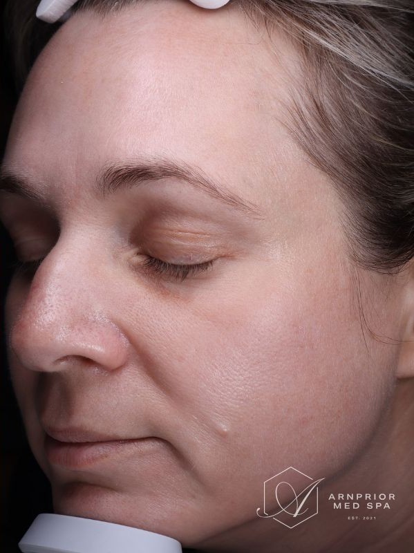 LaseMD Ultra Skin Resurfacing Melasma Hyperpigmentation, after