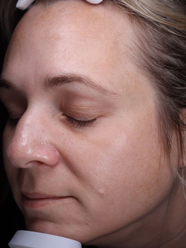 LaseMD Ultra Skin Resurfacing Melasma Hyperpigmentation, before