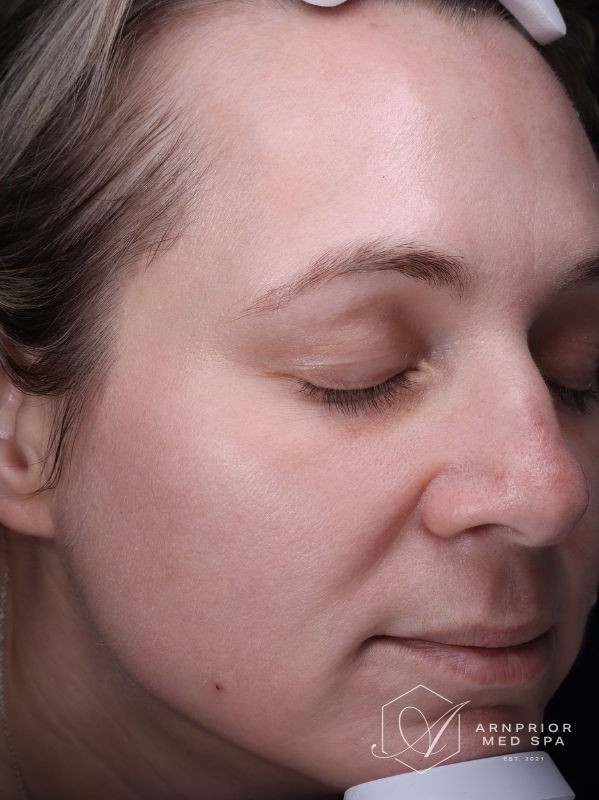Melasma hyperpigmentation after laser skin resurfacing