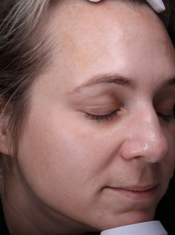 Melasma and hyperpigmentation before LaseMD Ultra laser skin resurfacing