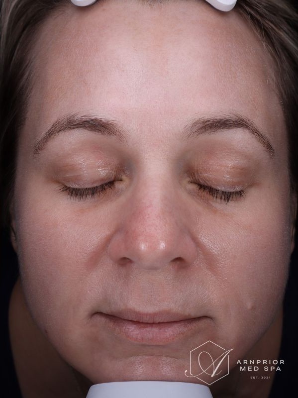 LaseMD Ultra Skin Resurfacing Melasma Hyperpigmentation, after