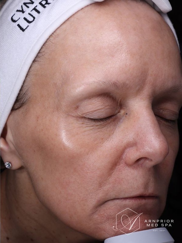 Sun damage, hyperpigmentation, and fine lines after laser skin resurfacing