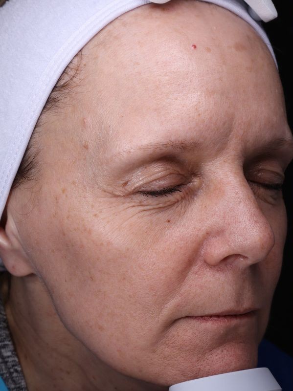 Sun damage, hyperpigmentation, and fine lines before laser skin resurfacing