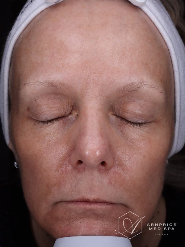 Sun damage, hyperpigmentation, and fine lines after laser skin resurfacing
