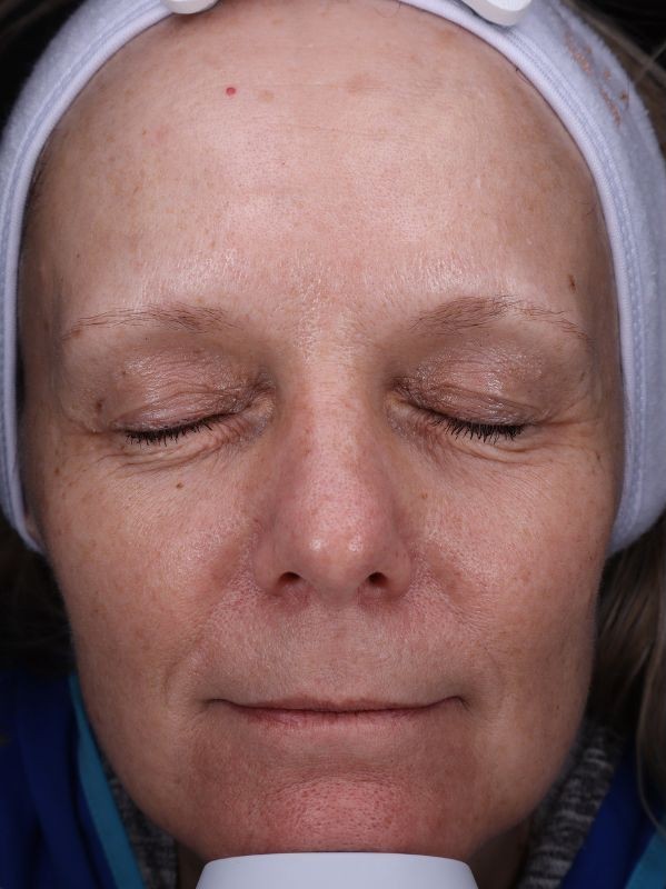 Sun damage, hyperpigmentation, and fine lines before laser skin resurfacing