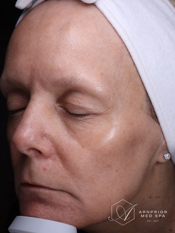 Fine lines after laser skin resurfacing