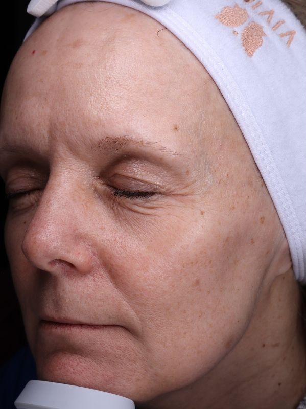 Fine lines before laser skin resurfacing