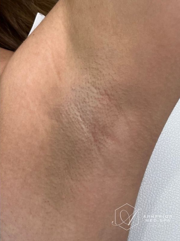 Laser Hair Removal Underarms Progress after 3 sessions, after