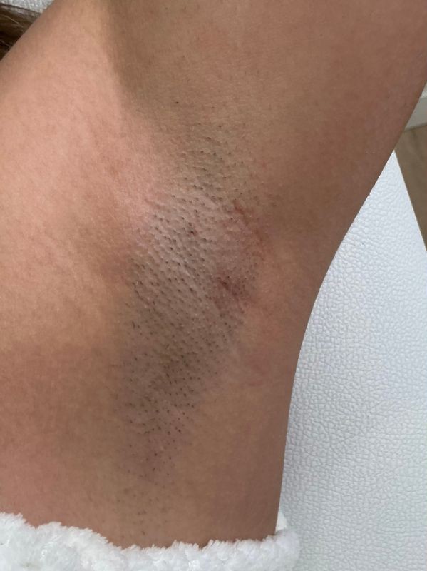 Laser Hair Removal Underarms Progress after 3 sessions, before