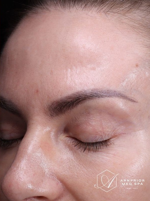 Uneven skin texture on the forehead and temple after laser resurfacing at Arnprior Med Spa
