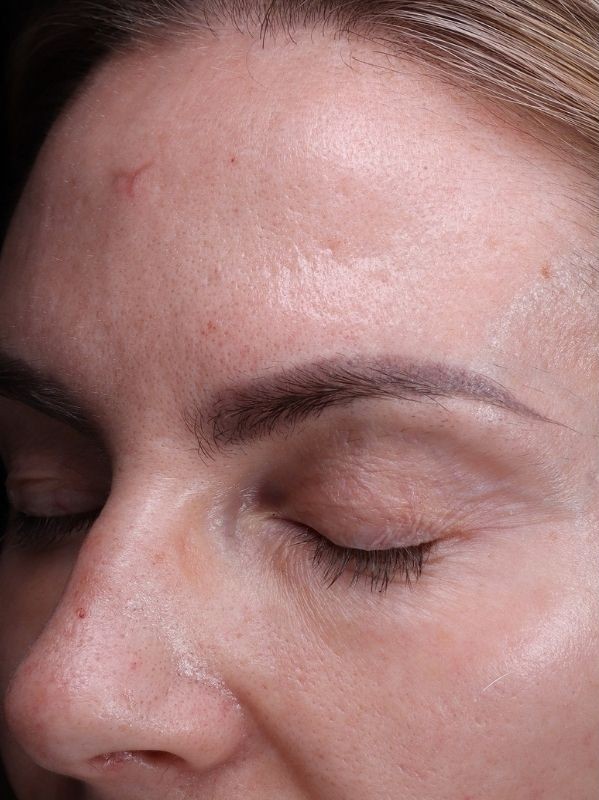 Uneven skin texture on the forehead and temple before laser resurfacing at Arnprior Med Spa