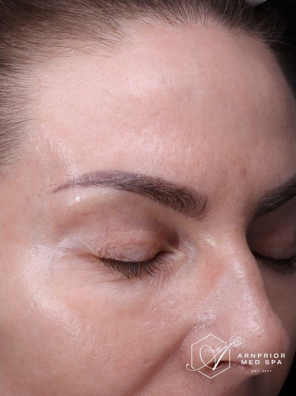 Skin texture around the eye and temple after laser resurfacing at Arnprior Med Spa
