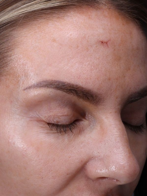 Skin texture around the eye and temple before laser resurfacing at Arnprior Med Spa