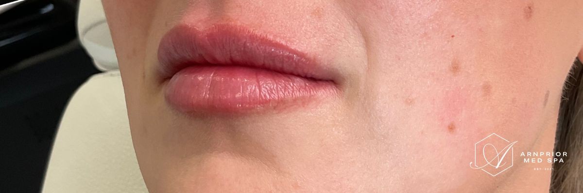 Lip filler after at Arnprior Med Spa