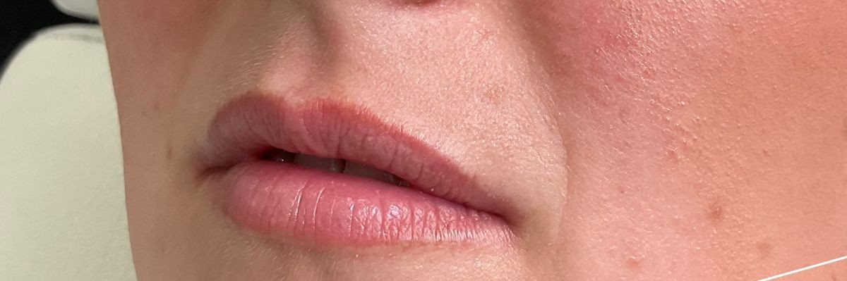 Lip filler before at Arnprior Med Spa