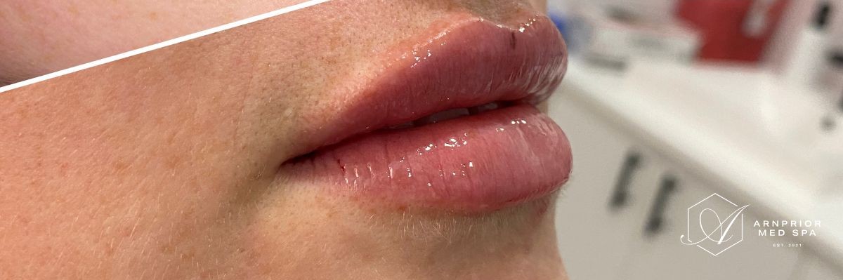 Lip filler after at Arnprior Med Spa