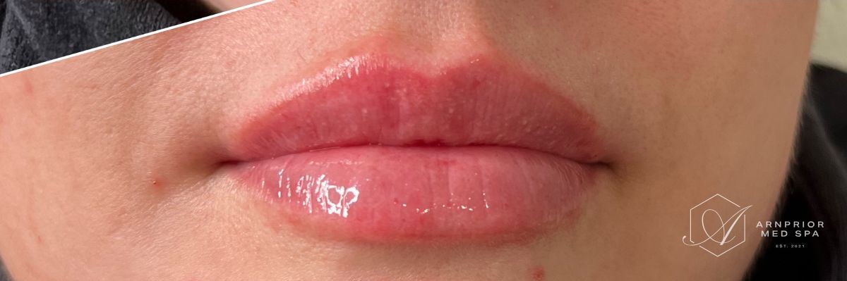 Lip filler after at Arnprior Med Spa