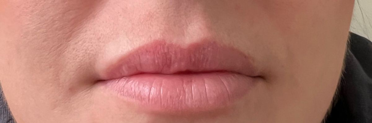Lip filler before at Arnprior Med Spa