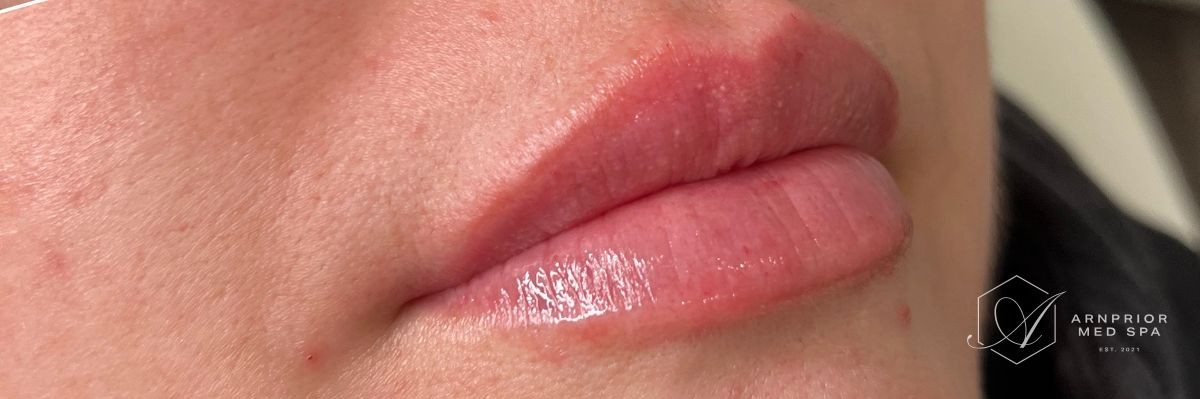 Lip filler after at Arnprior Med Spa