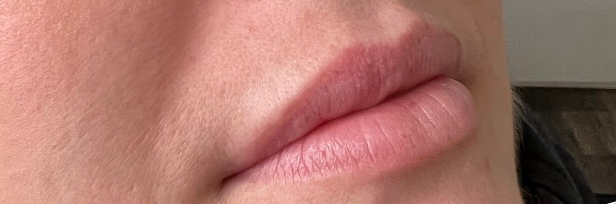 Lip filler before at Arnprior Med Spa