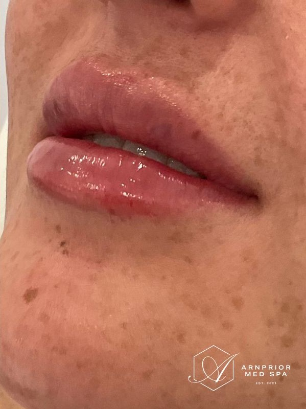 Lip filler after at Arnprior Med Spa