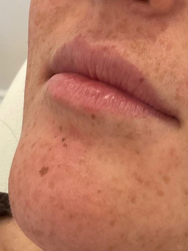 Lip filler before at Arnprior Med Spa