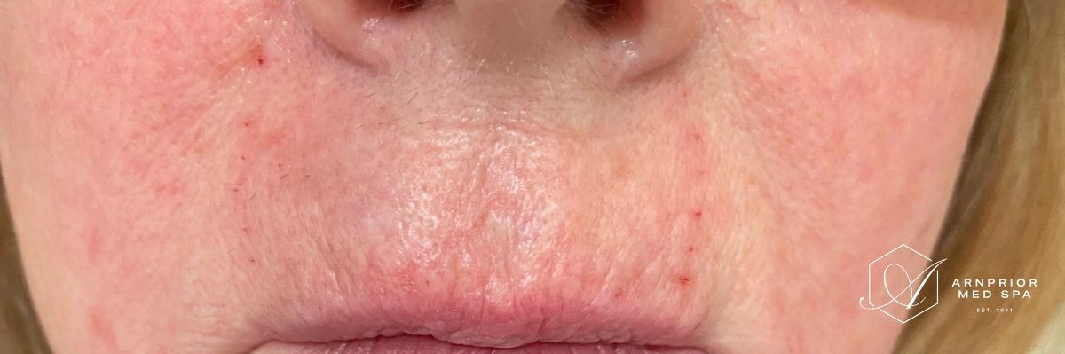 Lip lines after filler