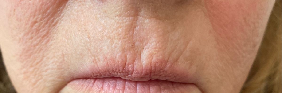 Lip lines before filler
