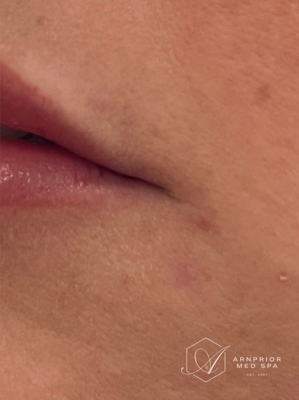 Lip mole after Removal with Plexr plasma device