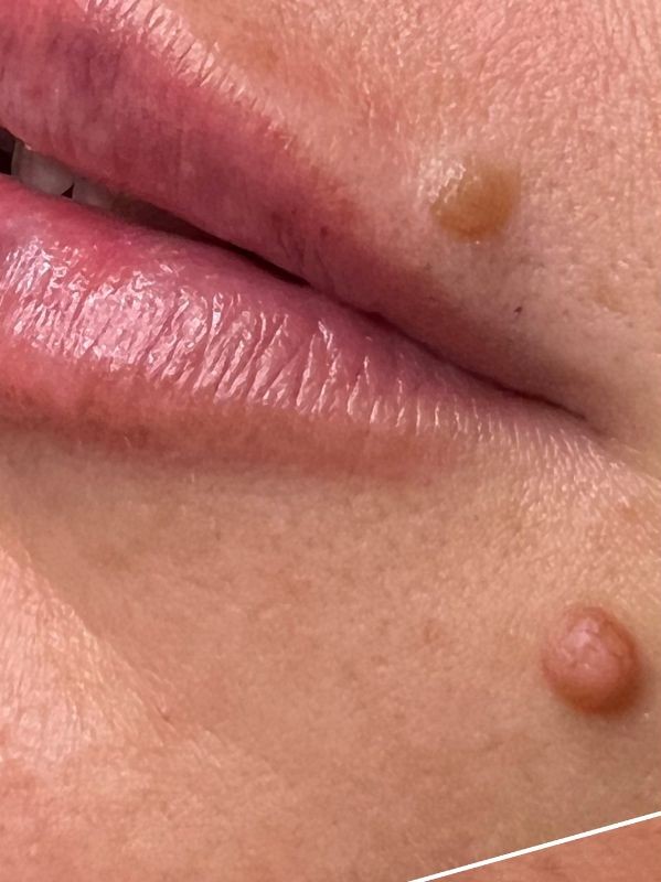 Lip mole before Removal with Plexr plasma device