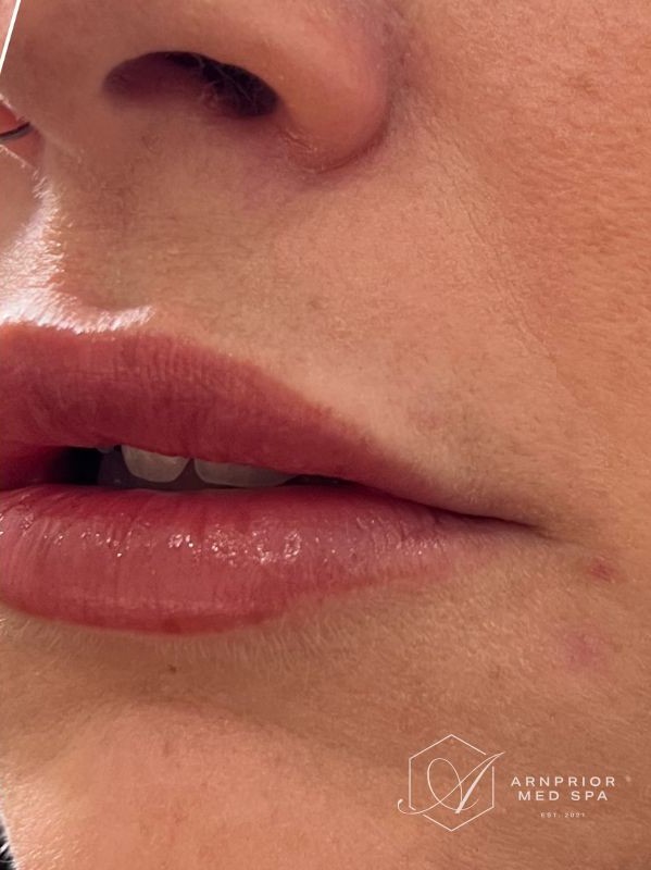 Lip moles after Removal with Plexr plasma device