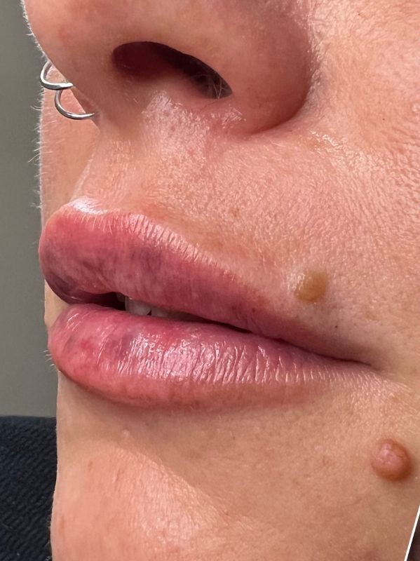 Lip moles before Removal with Plexr plasma device